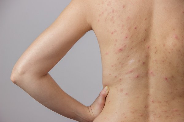 How to Get Rid of Back Acne | If you want to know what causes back acne, how to prevent it, how to treat it, and the best back acne remedies to try, this post is for you! Why there aren't any DIY natural treatments that work overnight (at least not that we know of!), these tips and products work fast. Whether you have occasional hormonal acne, or chronic cystic chest and back acne, it is possible to treat it at home so you can look and feel your best year-round!