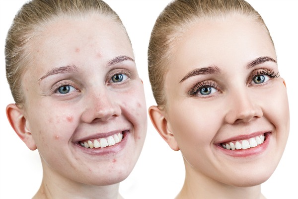 How to Get Rid of Acne Overnight | Want to know how to get rid of pimples and blemishes on your forehead, face, chest, and back fast (and naturally)? While these acne products and acne remedies won’t get rid of your bad skin instantly, these at home DIY ideas use things like toothpaste, aloe vera, lemon, and tea tree oil and will work quickly to help in your quest for flawless skin.