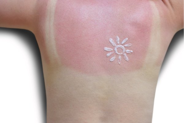 8 Natural Sunburn Remedies | If you're looking for relief from too much sun exposure, this post has 8 different natural remedy ideas to help cool and soothe your skin while also relieving pain and discomfort. These treatment tips use ingredients and products you probably already have in your home - Aloe Vera, witch hazel, coconut oil, and tea to name a few! While a severe and blistered sunburn should be seen by a doctor, these at home remedies offer quick overnight relief for mild sunburns!