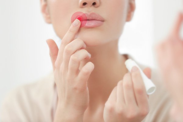 12 Natural Cold Sore Remedies that Work | If you want to know how to get rid of a cold sore FAST, this post is for you! Cold sores can cause significant pain in the mouth and on the lips, and while even the fastest remedies won’t cure a fever blister overnight, these ideas will decrease the severity and duration of cold sore symptoms. With DIY formulas using natural ingredients, these fast acting ideas are suitable for kids (and for toddlers!). #coldsore #feverblister #coldandflu